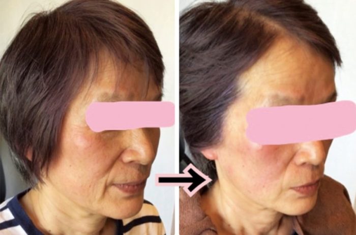 ★フェイストレーニング＆頭皮マッサージ 肌ハリ・弾力UP/スキンケア サキナミュー・テスラー本体/高周波美顔器/美肌・エステ美容★. ☆美品 フェイストレーニング＆頭皮マッサージ 肌ハリ・弾力UP